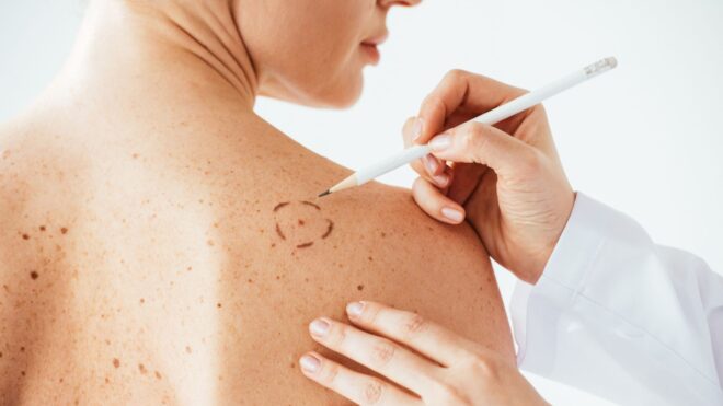 skin cancer
